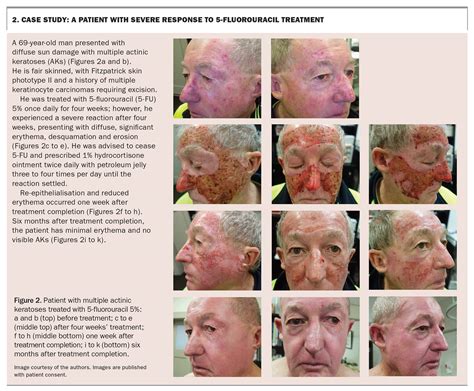 Actinic Keratoses A Guide To Treatment With 5 Fluorouracil Cream