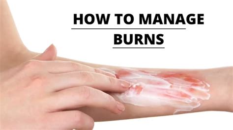 How To Manage Burns And Scalds Best Home Treatment For Mild Burns First Aid For Burns Youtube