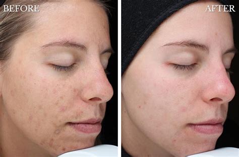 Chemical Peels Treatments Boston MA Westford Dermatology