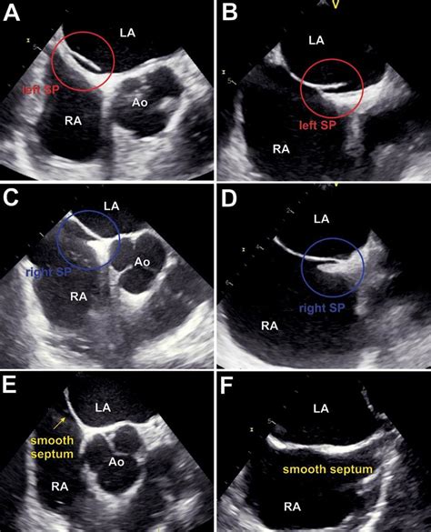 Mid Esophageal Short Axis And BiCaval Views Of Interatrial Septum In