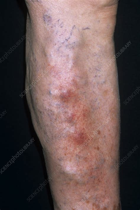 Superficial Thrombophlebitis Groin