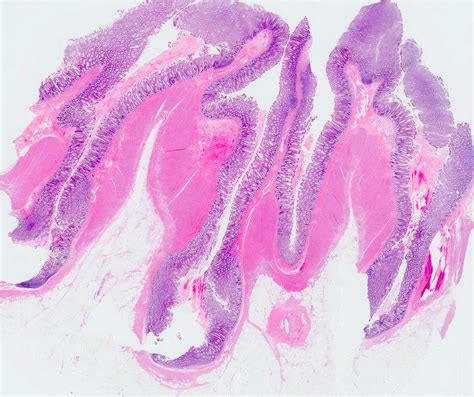 Meckel Diverticulum Histology