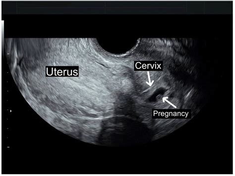 Pregnant Cervix Telegraph