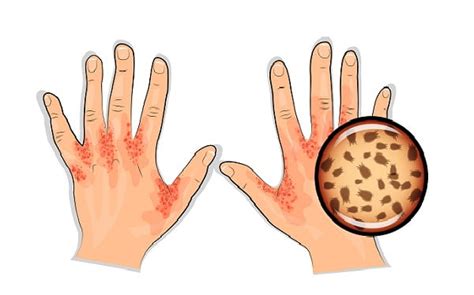 Signs Risks And Treatment Of Crusted Scabies Diseasefix