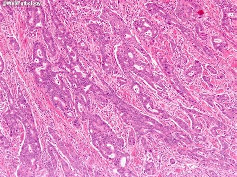 Adenocarcinoma in Barrett Esophagus