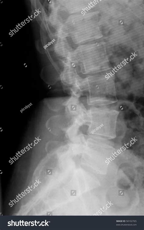 Lateral Xray Lower Back Stock Photo 58102765 - Shutterstock