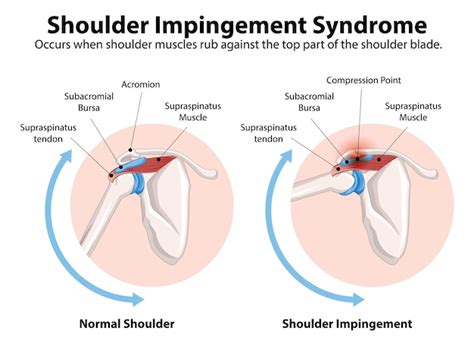 Free Vector Understanding Shoulder Impingement Syndrome