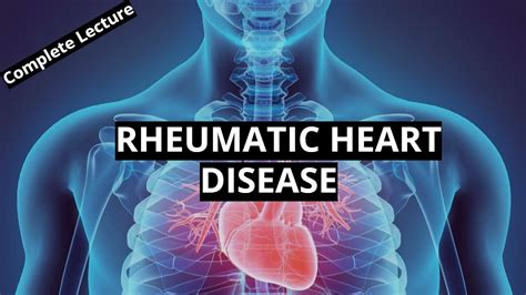 rheumatic heart disease symptoms Rheumatic symptoms - Diseases Club ...