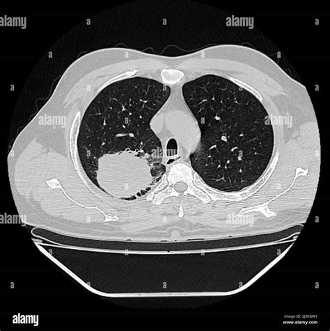 Lung Carcinoma Ct Scan Stock Photo Alamy