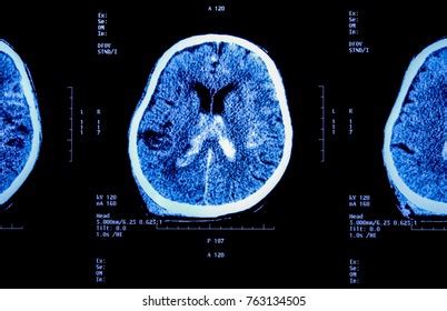 Mri Brainxray Film Brain Computed Tomography Stock Photo