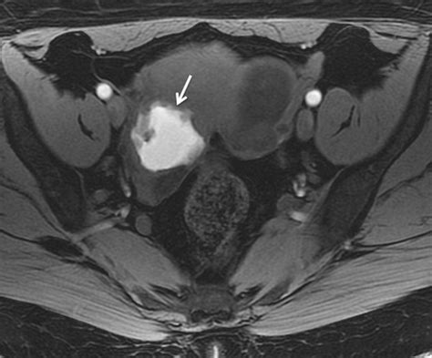 T1 Weighted Fat Suppressed Imaging Of The Pelvis With A Dual Echo Dixon