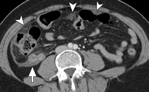 Neoplasms Of The Appendix Pictorial Review With Clinical And