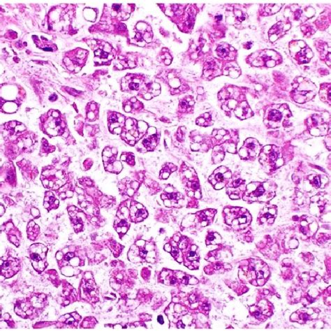 Centrilobular Confluent Coagulative Hepatocellular Necrosis Download Scientific Diagram