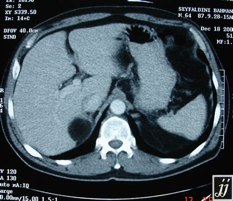 Right Adrenal Mass Radiopaedia