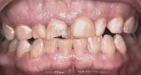Full Contour Crowns Before Eagle Harbor Dentist