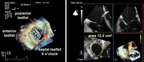 3d Narrow Sector Acquisition Of The Tricuspid Valve Tv A En Face