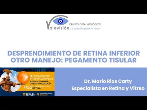 DESPRENDIMIENTO DE RETINA INFERIOR OTRO MANEJO PEGAMENTO TISULAR