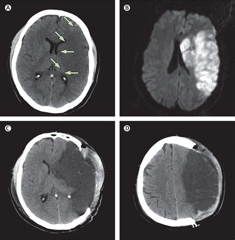 Malignant Middle Cerebral Artery Infarction Clinical Characteristics Treatment Strategies And