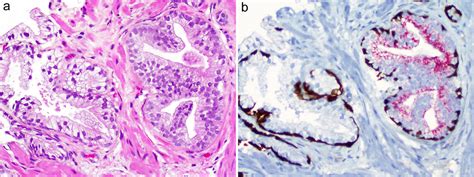 Updates Of Prostate Cancer From The 2022 World Health Organization Classification Of The Urinary