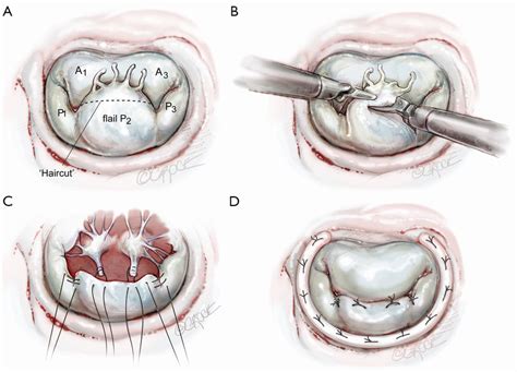 Haircut Mitral Valve Repair Posterior Leaflet Plasty Chitwood Jr