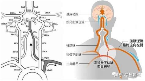 “盗血”笔记——锁骨下动脉盗血综合征 知乎