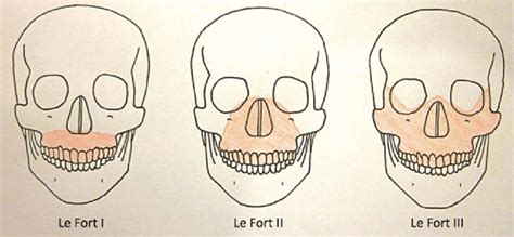 Le Fort Classification Of Facial Fractures Download Scientific Diagram