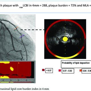 Representative Image Of Near Infrared Spectroscopy And Intravascular