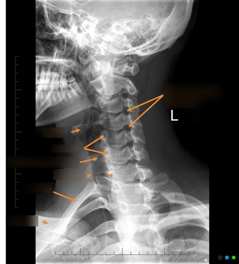 X Ray Oblique View Of Cervical Spine Diagram Quizlet