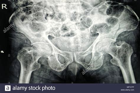 Pubic Bone Stock Photos & Pubic Bone Stock Images - Alamy