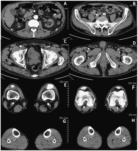Angio Ct Scan Of The Vascular Axis In The Case Patient A Abdominal