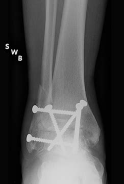 Comparing Ankle Arthrodesis to Ankle Arthroplasty - Center for Limb ...