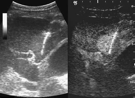 Large Hepatic Tumor With Extensive Necrosis Ceus Guided Liver Biopsy