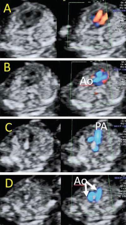 Congenital Abnormalities Of The Fetal Heart Intechopen