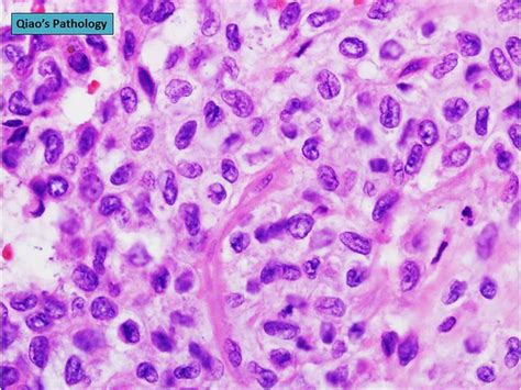 Qiaos Pathology Adult Granulosa Cell Tumor Of Ovary A Photo On