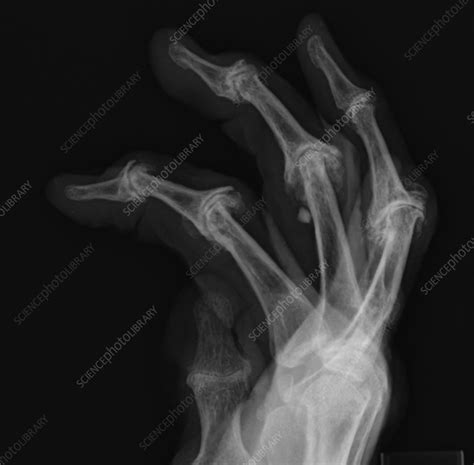 Psoriatic arthritis, X-ray - Stock Image - C058/4528 - Science Photo Library