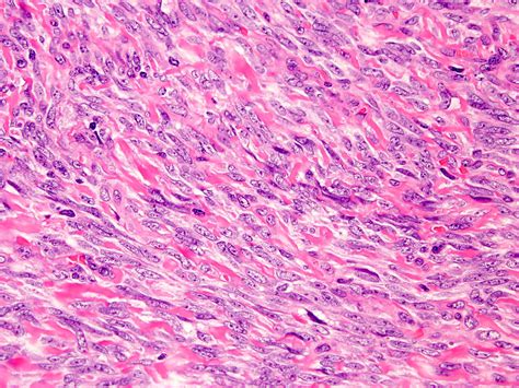 Synovial Sarcoma Histology