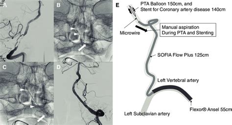 Vertebral Artery Stenosis Symptoms