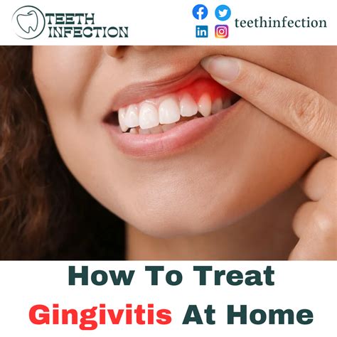 How To Treat Gingivitis At Home Gingivitis Is A Common Gum Disease