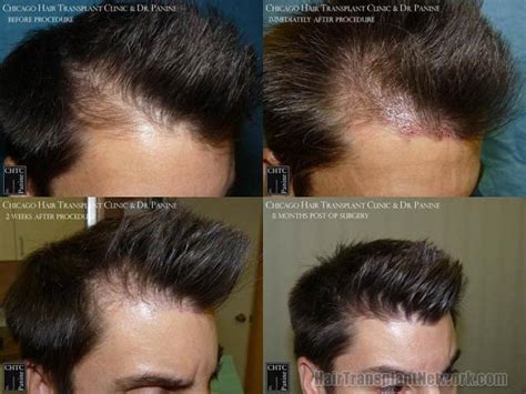 Dr Vladimir Panine Hair Restoration Procedure Before And After Result Images With 3616 Grafts