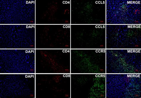 Frontiers Ccl5 Mediates Breast Cancer Metastasis And Prognosis