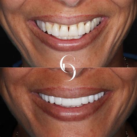 Who Does Porcelain Veneers Near Me Cosmetique Dental