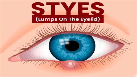 Stye Symptoms Treatment And Prevention