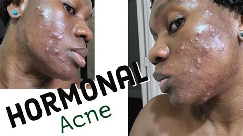 My Hormonal Acne Adult Cystic Acne What Its All About How To