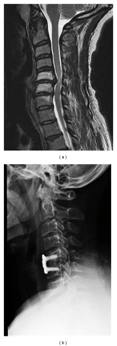 A Sagittal Mri Demonstrating C5 6 Extruded Disc Herniation B Download Scientific Diagram