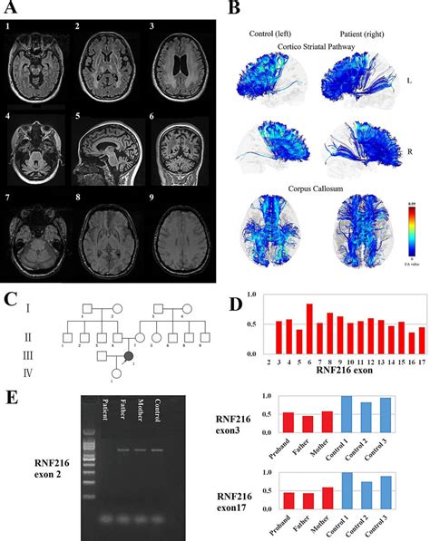 Clinical Features Of The Proband And Segregation Analysis Of The Rnf216 Download Scientific