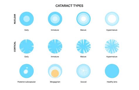 Cataract Eye Disease Royalty Free Vector Image