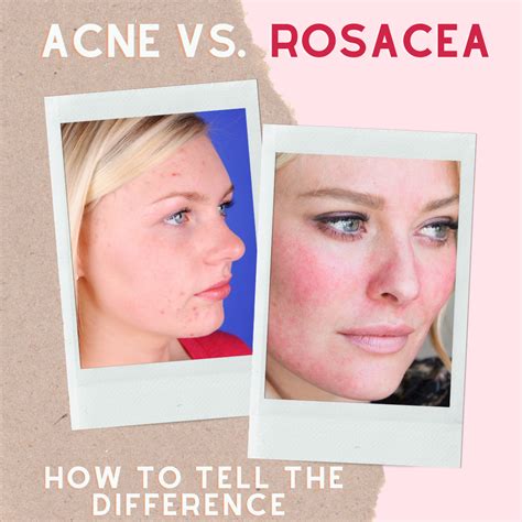 Acne Vs Rosacea Rosacea Symptoms Rosacea Skin Care Blog Of Organic Radiance Skincare