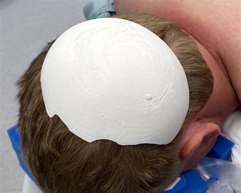 3D Printed Skull Implant Model Placed On Patient S Head Dr Barry Eppley