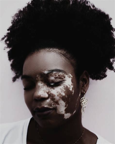 Wow Black Girl Magic Black Girls Black Women What Is Vitiligo