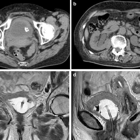 Pdf Bladder Metastasis Without Hematuria Following Radiation Therapy